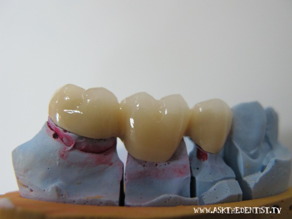 Affordable fixed partial denture